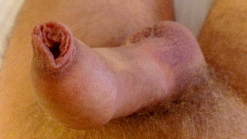 Long foreskin